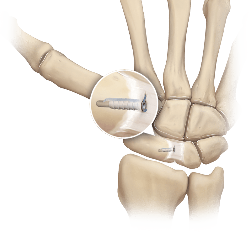 Carpal Instability