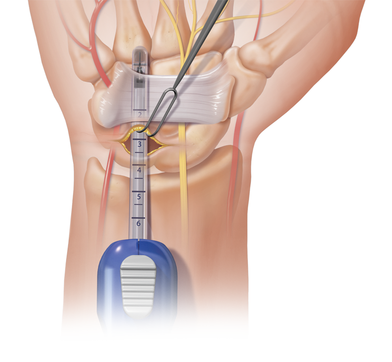 Carpal Tunnel