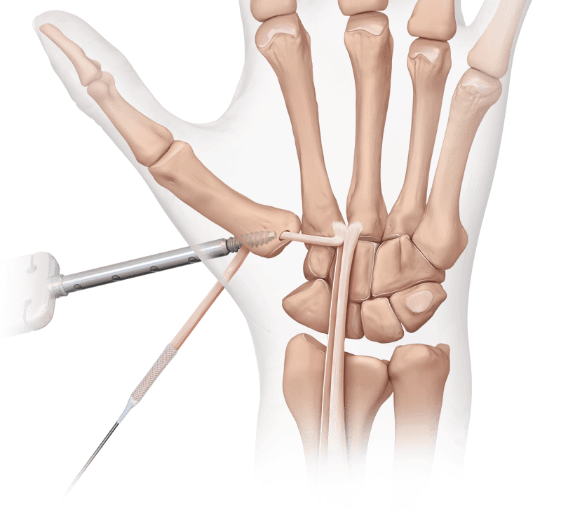 CMC-Arthrose