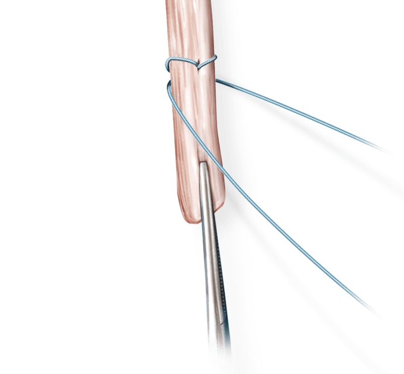 Rekonstruktion von Beuge- und Strecksehnen mit FiberWire<sup>®</sup>