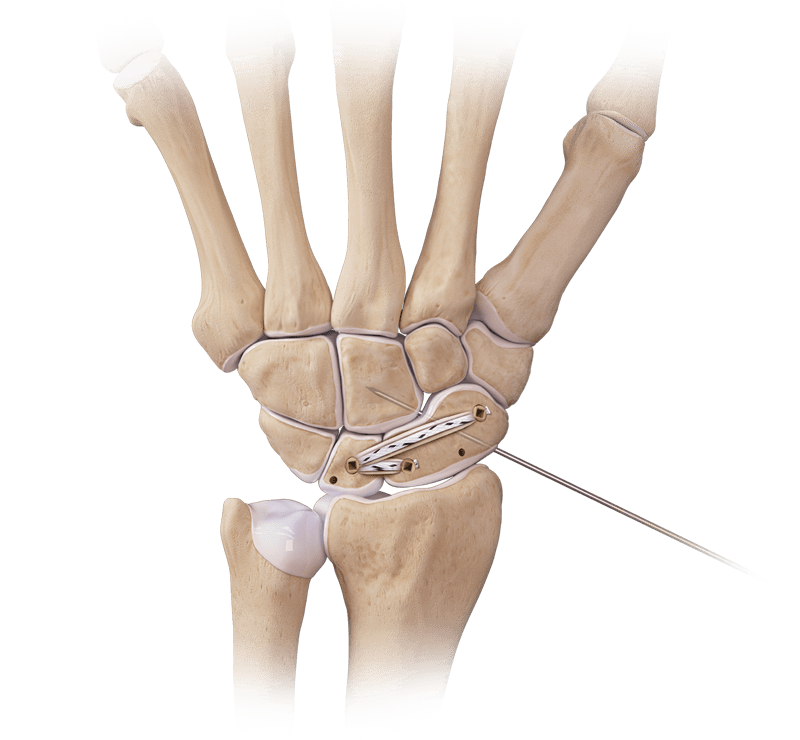 DX SwiveLock<sup>®</sup> SL Anchor for Scapholunate Ligament Repair