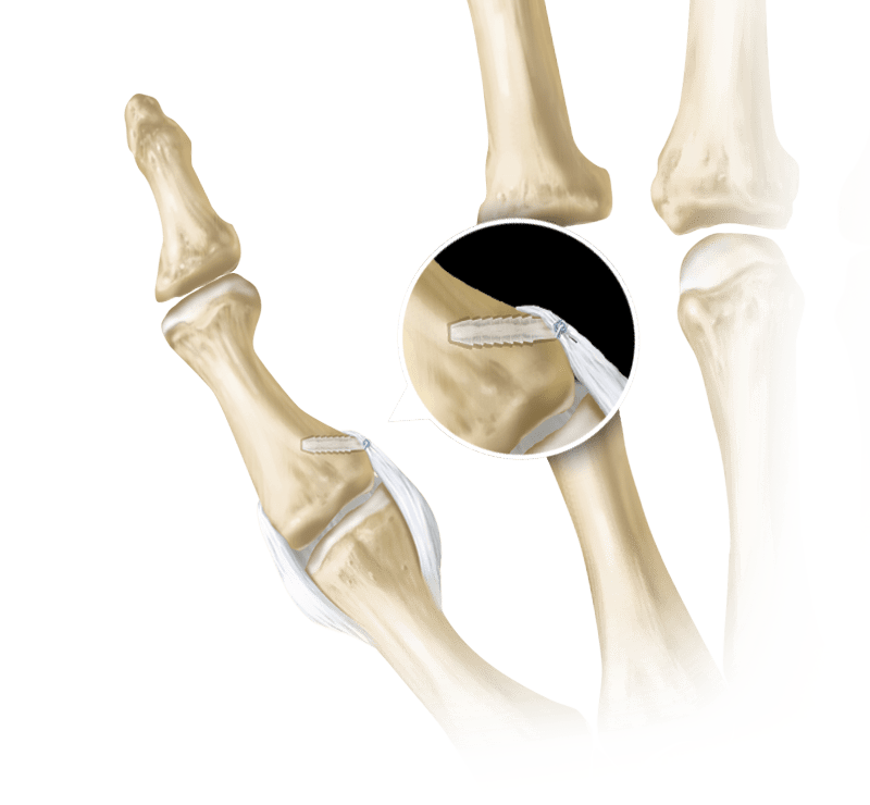 SutureTak<sup>®</sup> Thumb Collateral Ligament Repair