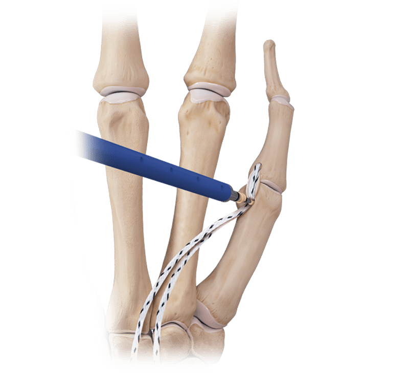 Reconstrução do ligamento colateral do polegar com DX SwiveLock<sup>®</sup> SL