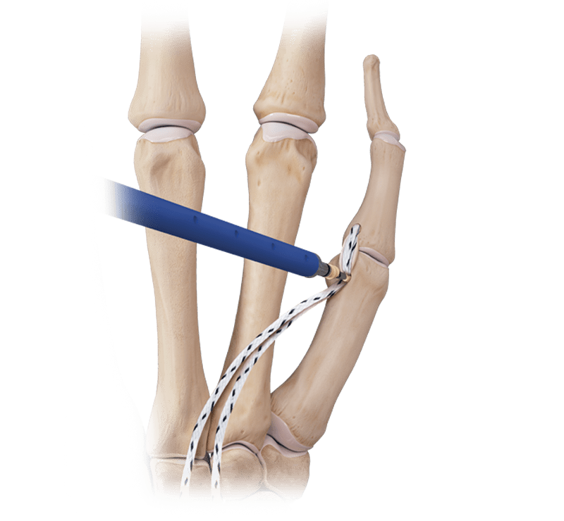 Reconstrucción del ligamento colateral del pulgar con DX SwiveLock<sup>®</sup> SL