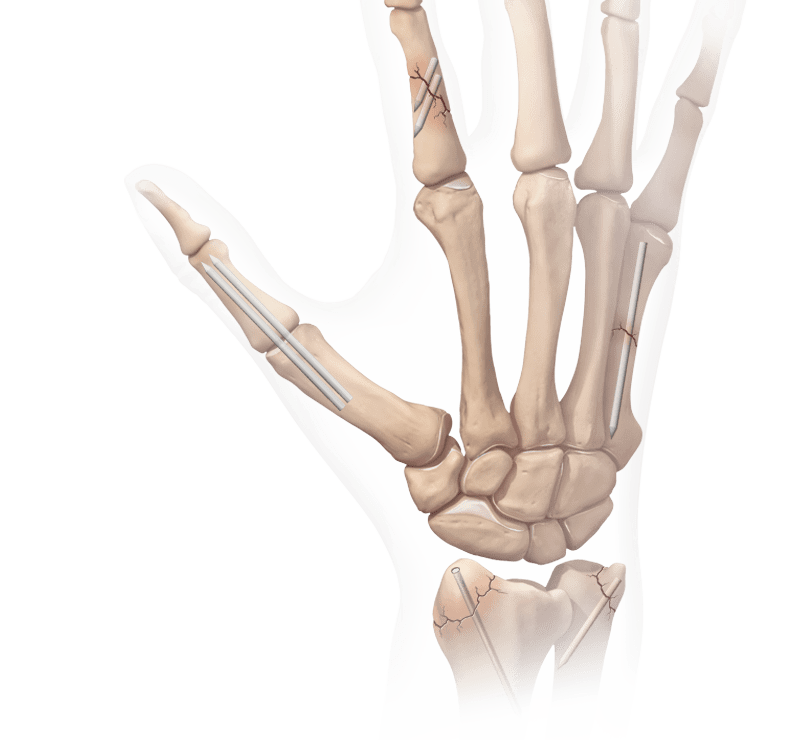 Interphalangeal-Arthrodesen