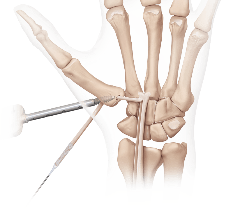 Reconstrução do ligamento - Interposição do tendão