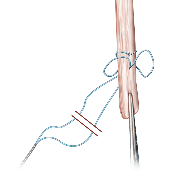 Laceración del tendón flexor/extensor