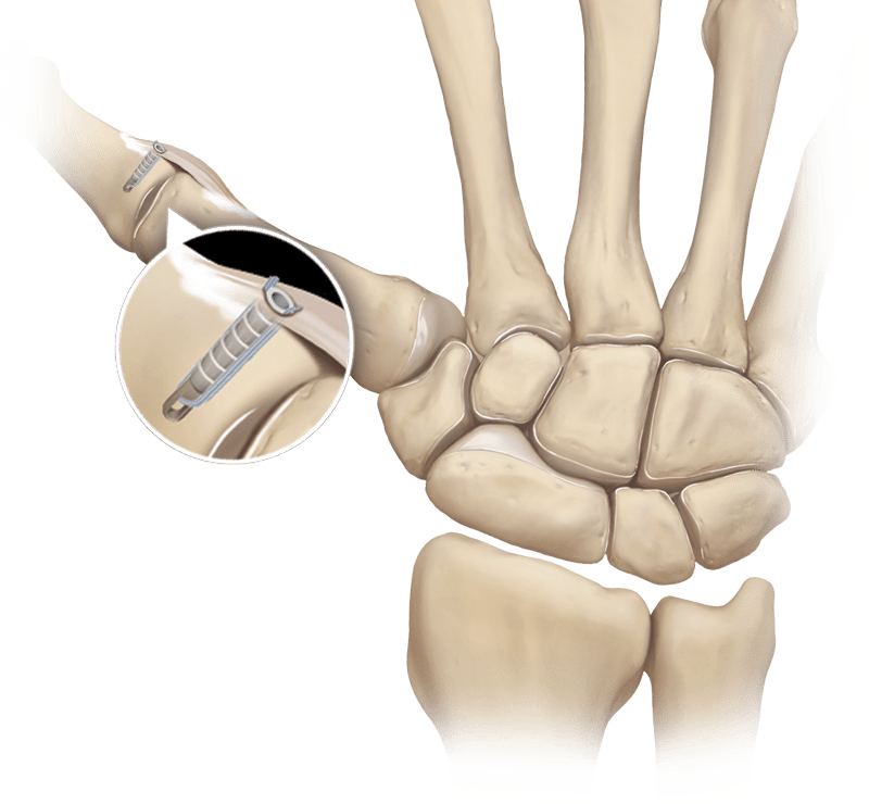 2.5 mm PushLock<sup>®</sup>  Thumb Collateral Ligament Repair