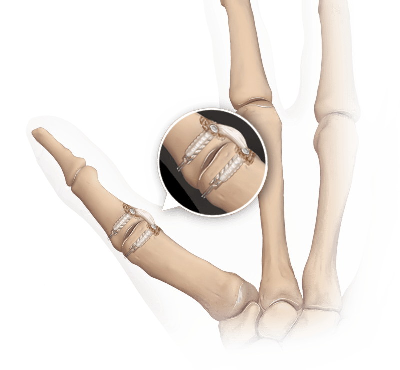 Thumb 
Metacarpophalangeal (MCP)
 Radial and Ulnar Collateral
 Ligament (UCL) 
Reconstruction