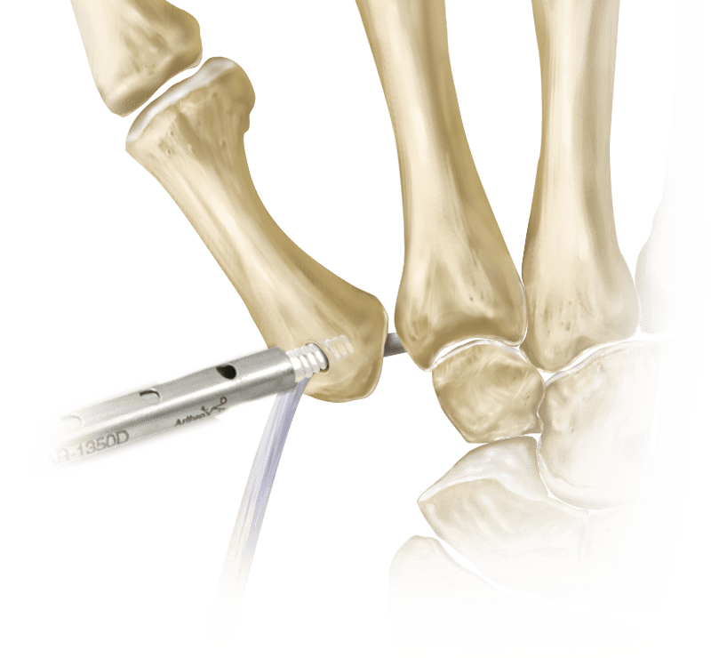 Reconstrucción del ligamento CMC