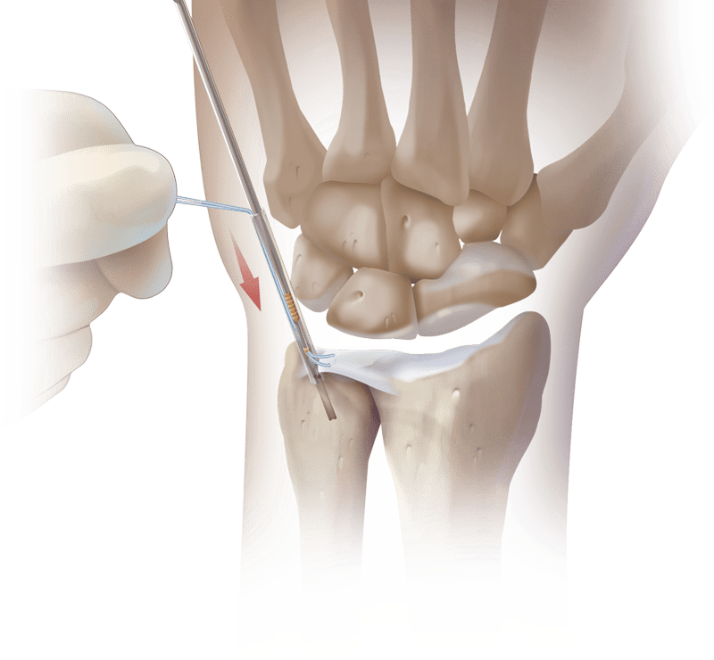 Arthroscopy