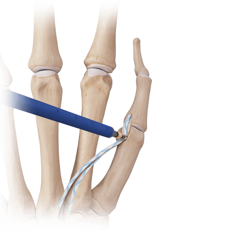 Hand/Wrist <em>Internal</em>Brace™ Ligament Augmentation Repair