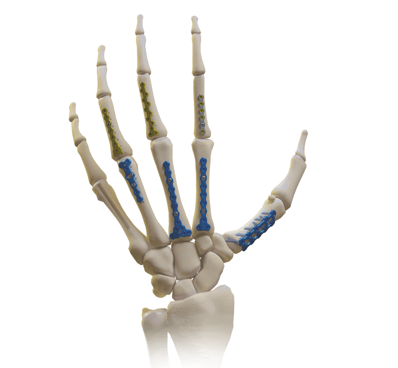 Umfassendes Mini-Fixierungssystem (Hand und Handgelenk)