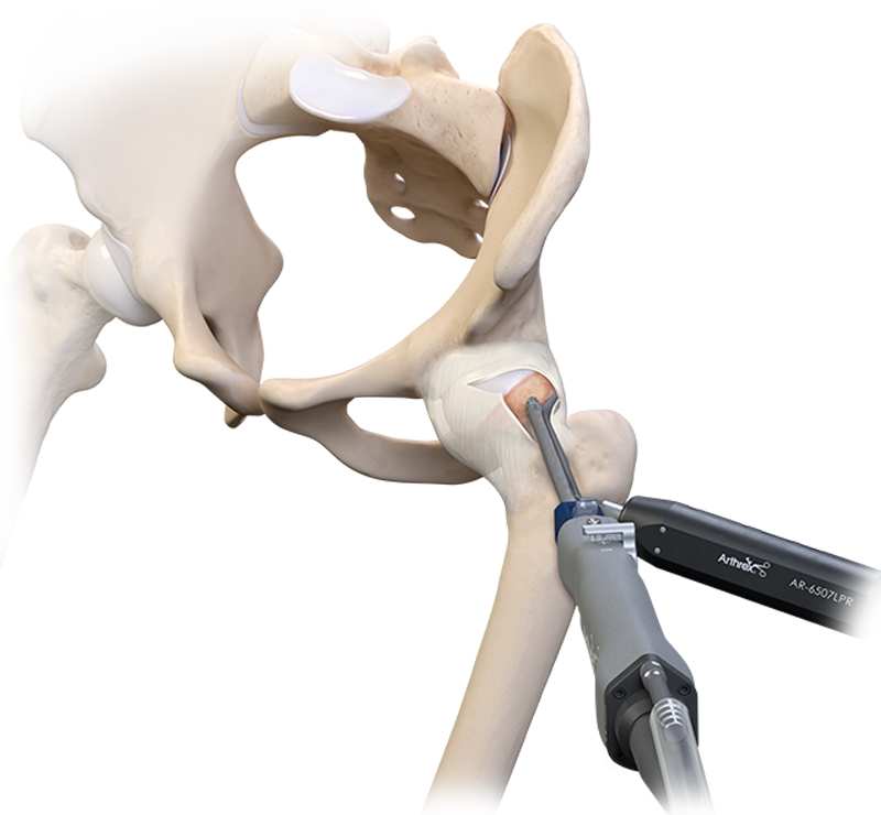 Pinzamiento femoroacetabular