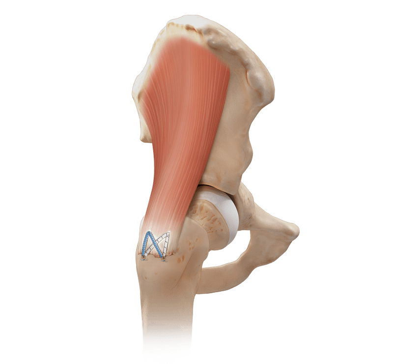 Ruptur des Gluteus medius