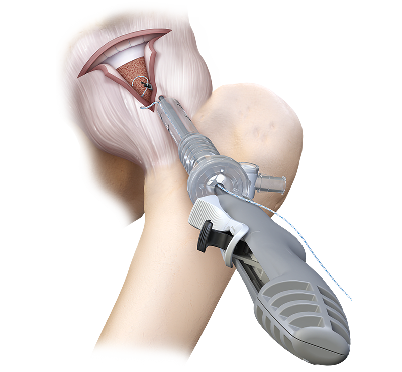 CapsuleStitch™ Suture Passer 