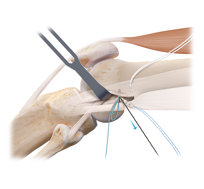 Lateral Extra-Articular Tenodesis