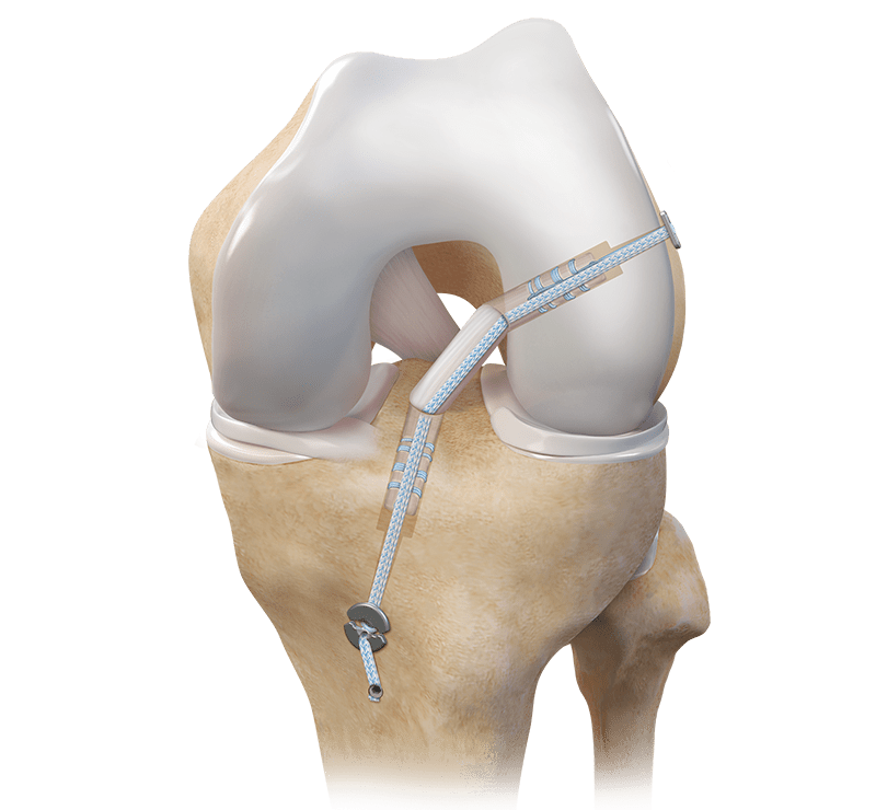 Allograft ACL Reconstruction