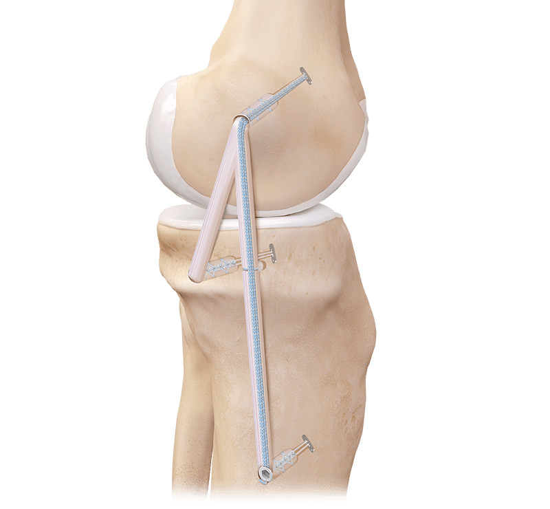 Medial Collateral Ligament (MCL) Reconstruction