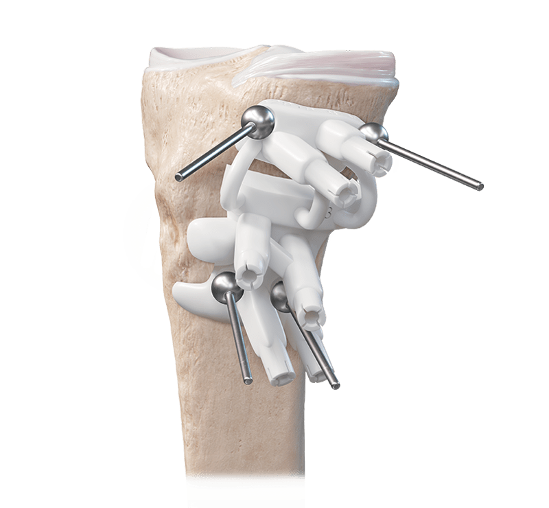 Patient-Specific Instrumentation (PSI) Osteotomy Guides
