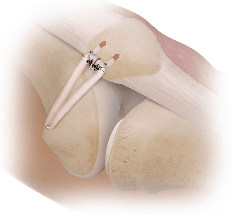 Patellofemoral Pathology 