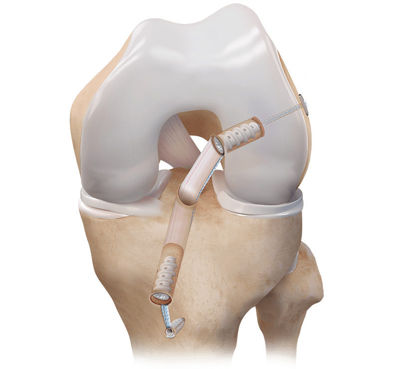 Reconstrução do LCA com autoenxerto osso-tendão-osso