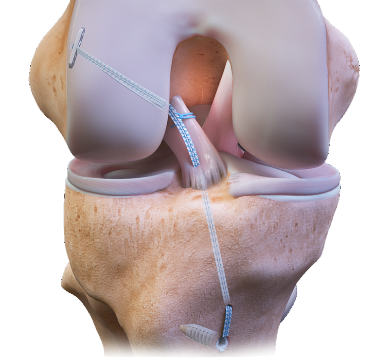 Cruciate Injury 