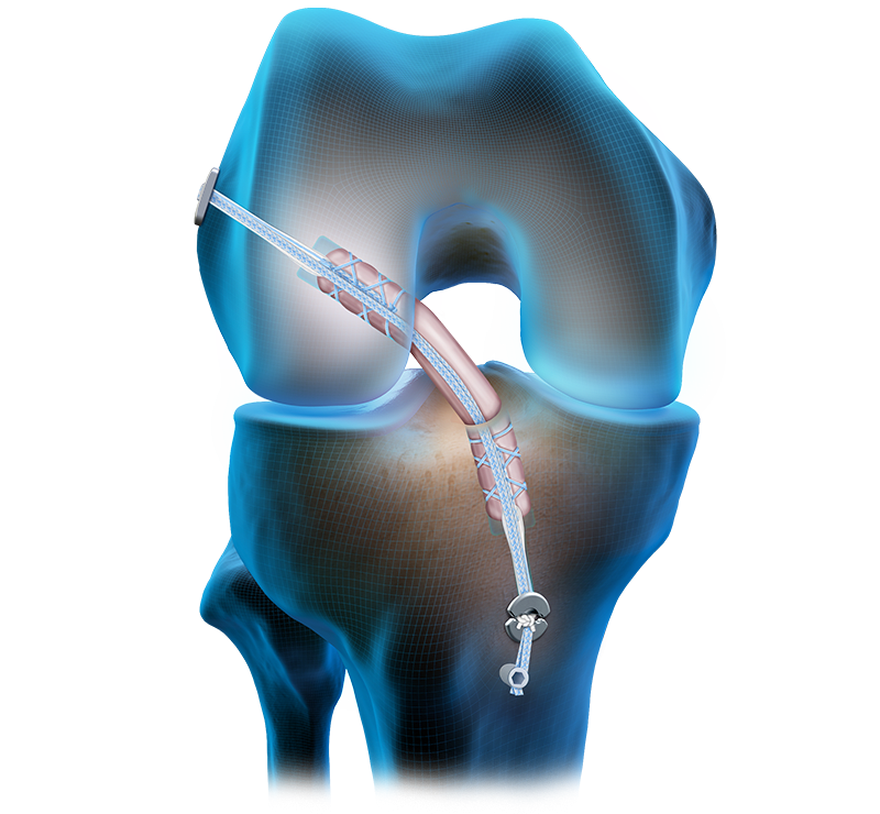 Quad Tendon Graft ACL Reconstruction