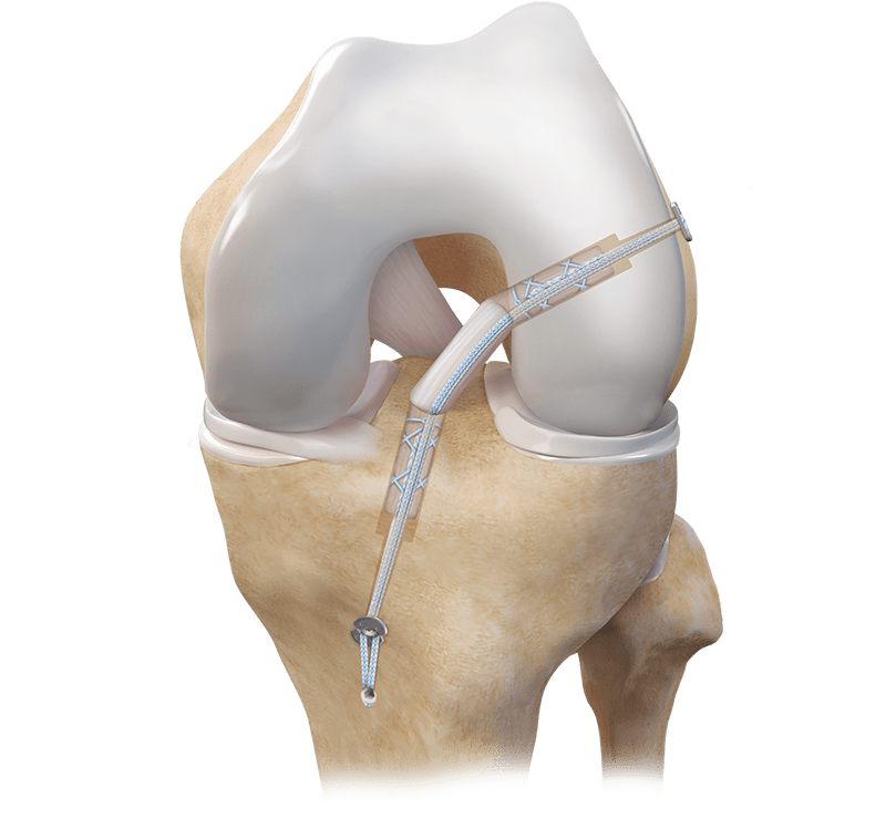 ACL Soft-Tissue Graft Fixation