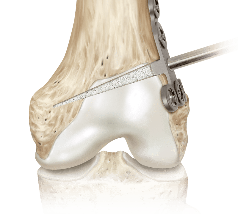 OSferion Bone Void Filling