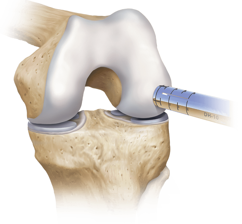 Chondral Defect