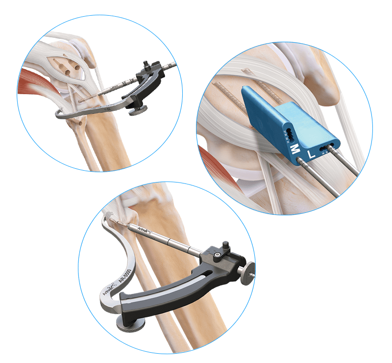 Reconstrução anatômica do ligamento colateral