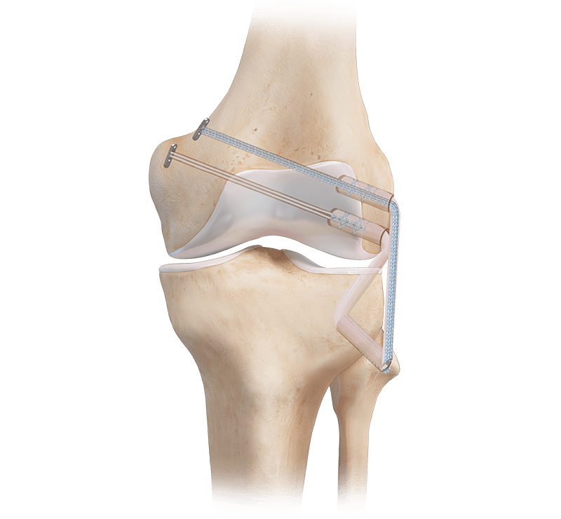 Fixação de enxerto no ligamento colateral