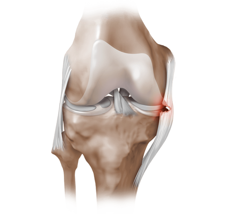 Lesión del ligamento colateral