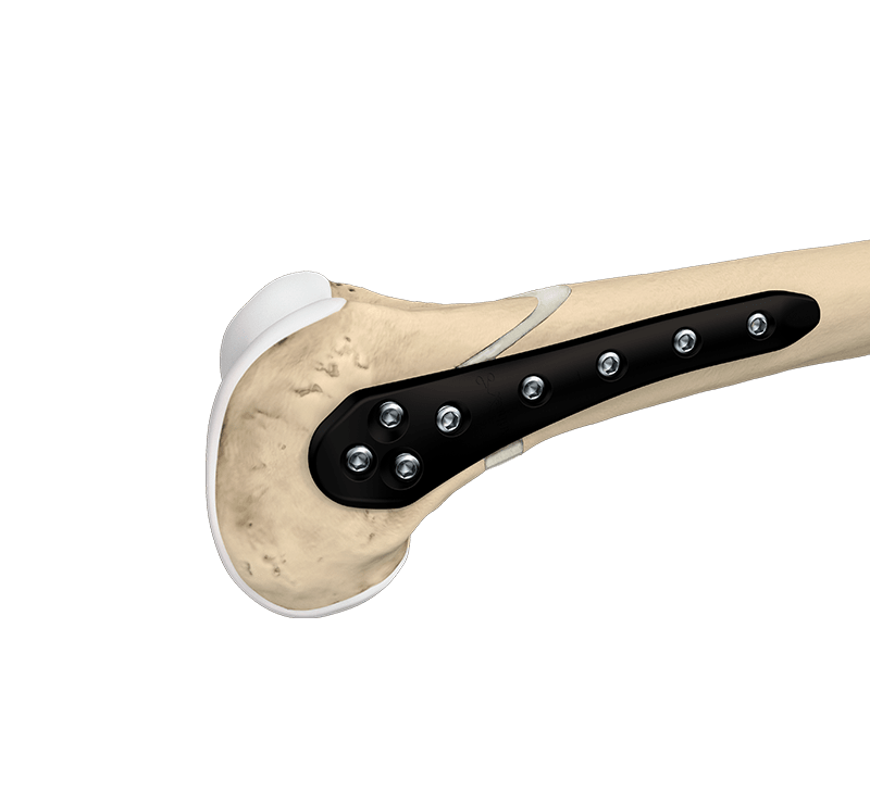 Distal Femoral Osteotomy