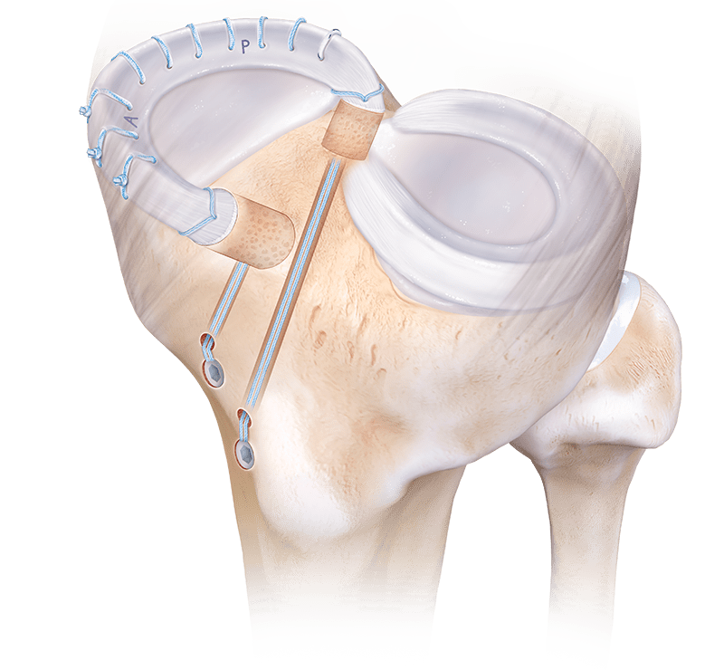 Double Bone Plug Meniscal Transplant