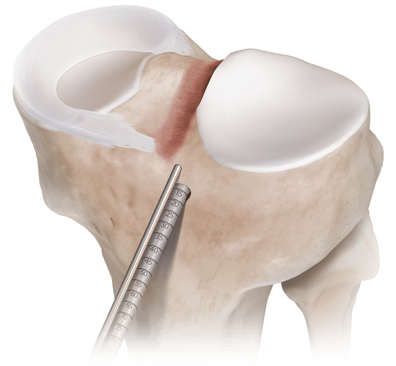 Técnica de transplante de meniscos DoveTail