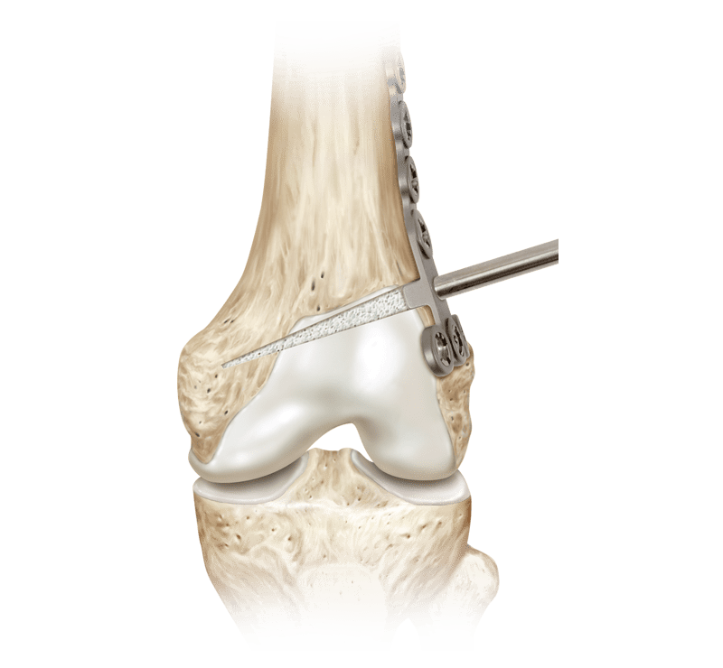 Femorale Opening Wedge-Osteotomie