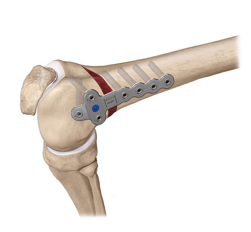 Osteotomía femoral distal