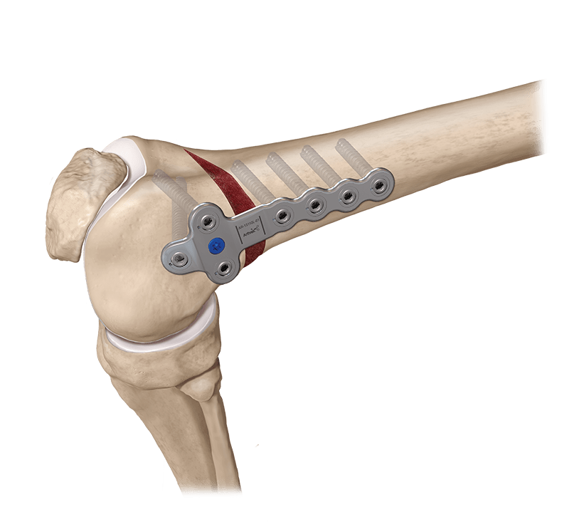 Osteotomia femoral distal