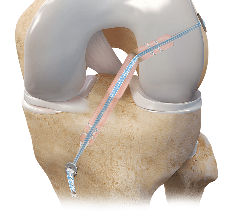 Hamstring Autograft ACL Reconstruction