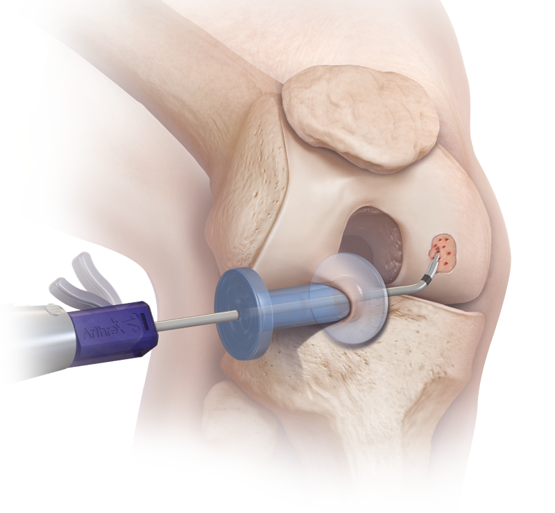 Microfractura