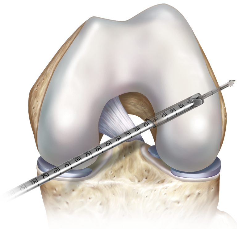 Preparación del orificio femoral a través del portal medial