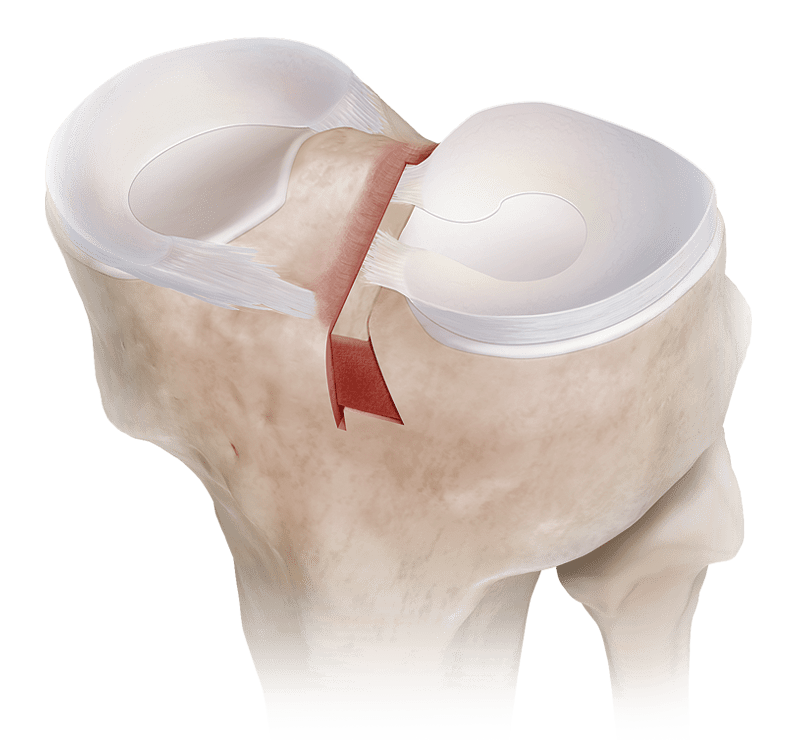 Meniscal Transplant Procedure