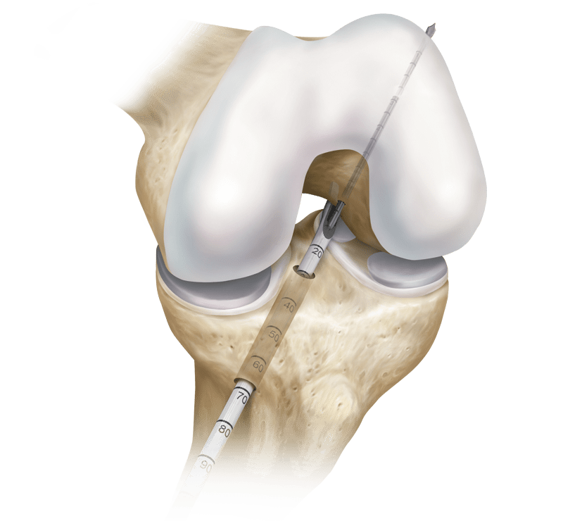 Reconstrucción transtibial del LCA