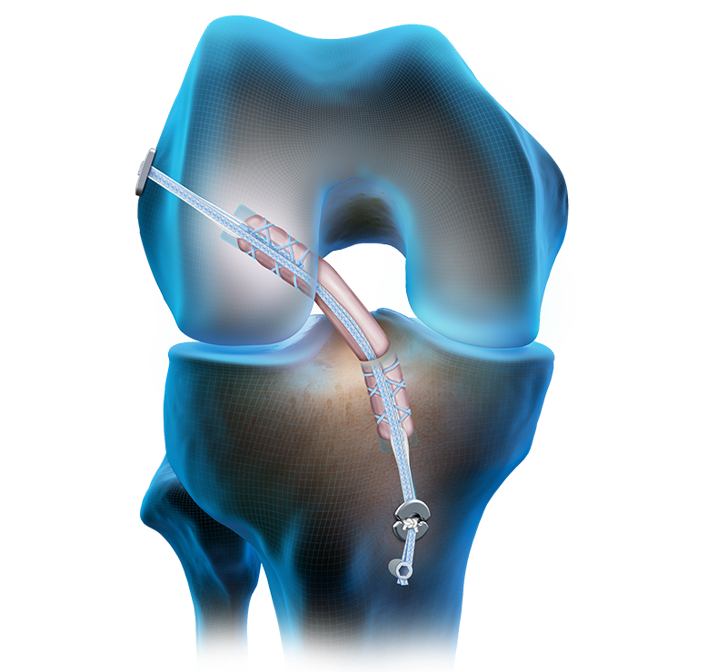 FiberTag®-TightRope® II-Implantat