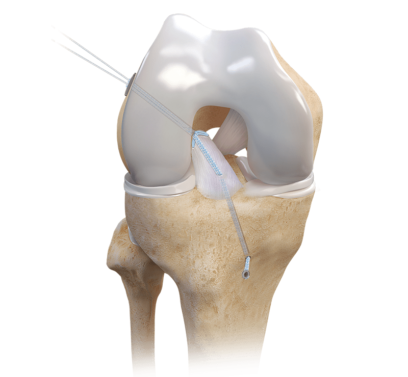 ACL Repair TightRope® Implant With FiberRing™ Sutures