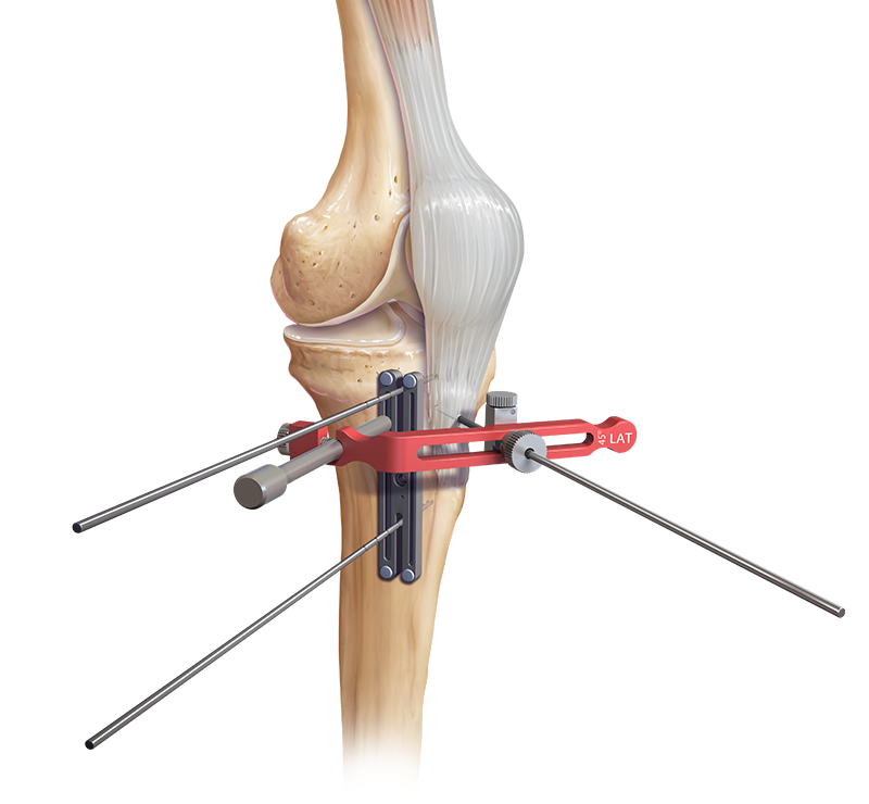 Sistema T3 AMZ para osteotomía de tuberosidad tibial