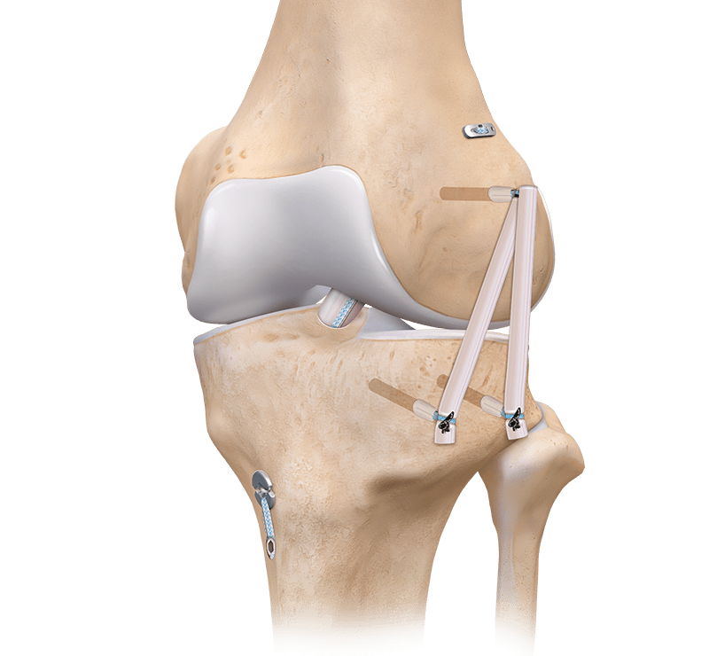 Rekonstruktion des anterolateralen Bandes