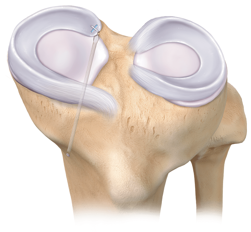 Reparación de raíz meniscal